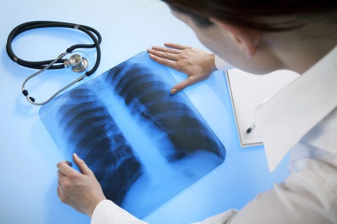Doctor examines x-ray image of lungs lying on the light table