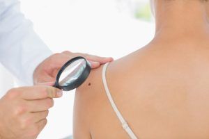 Mureș: Campanie de depistare precoce a cancerului de piele